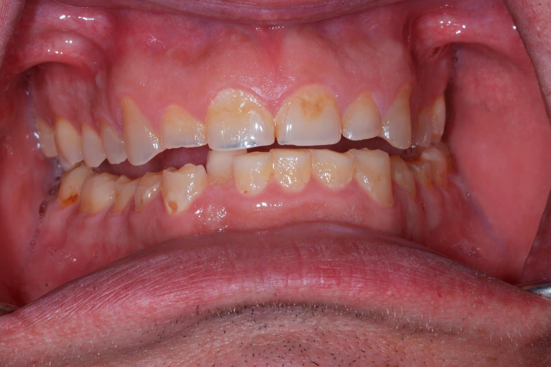 Tandlæge - Syreskadede tænder